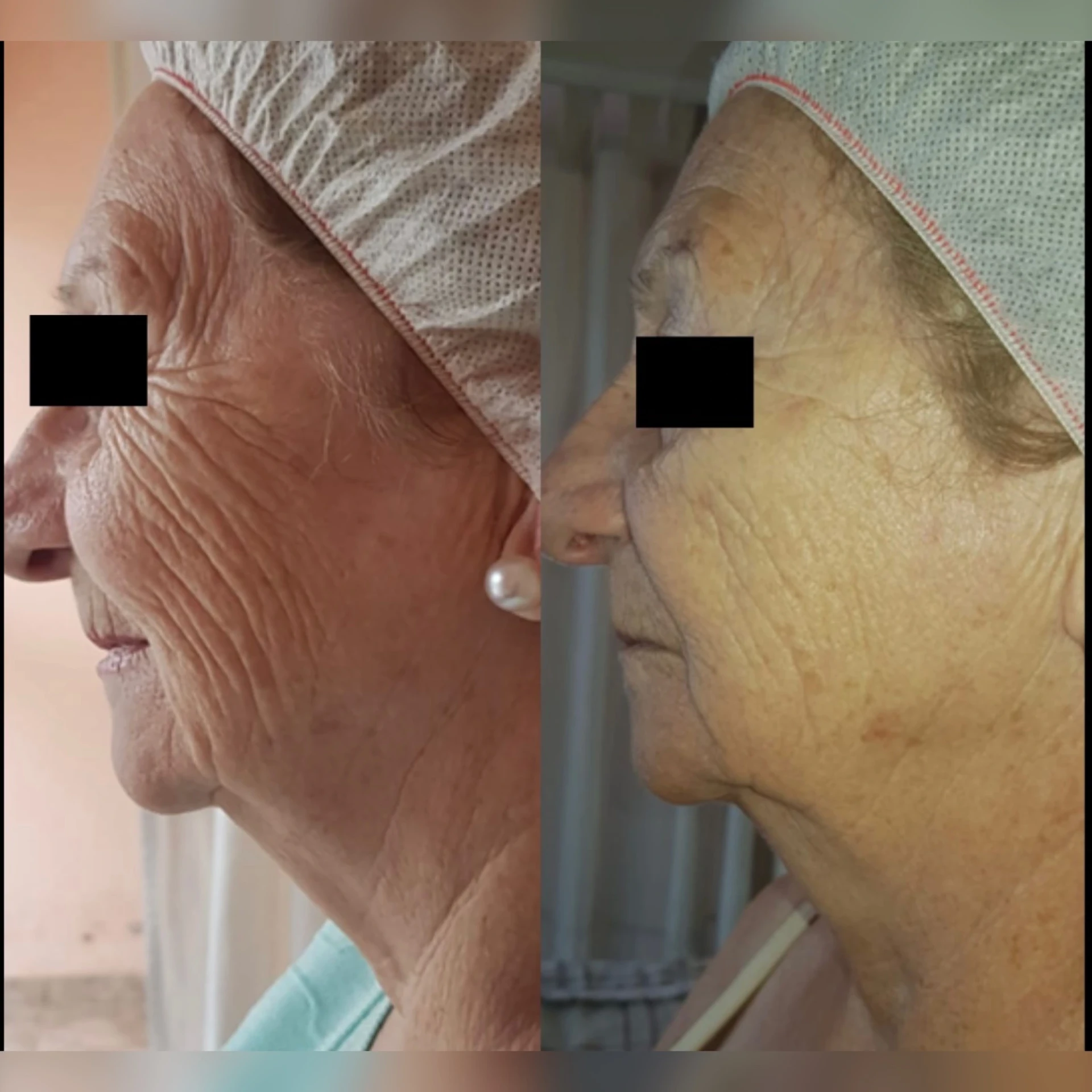 Caso real HIFU - 3 meses