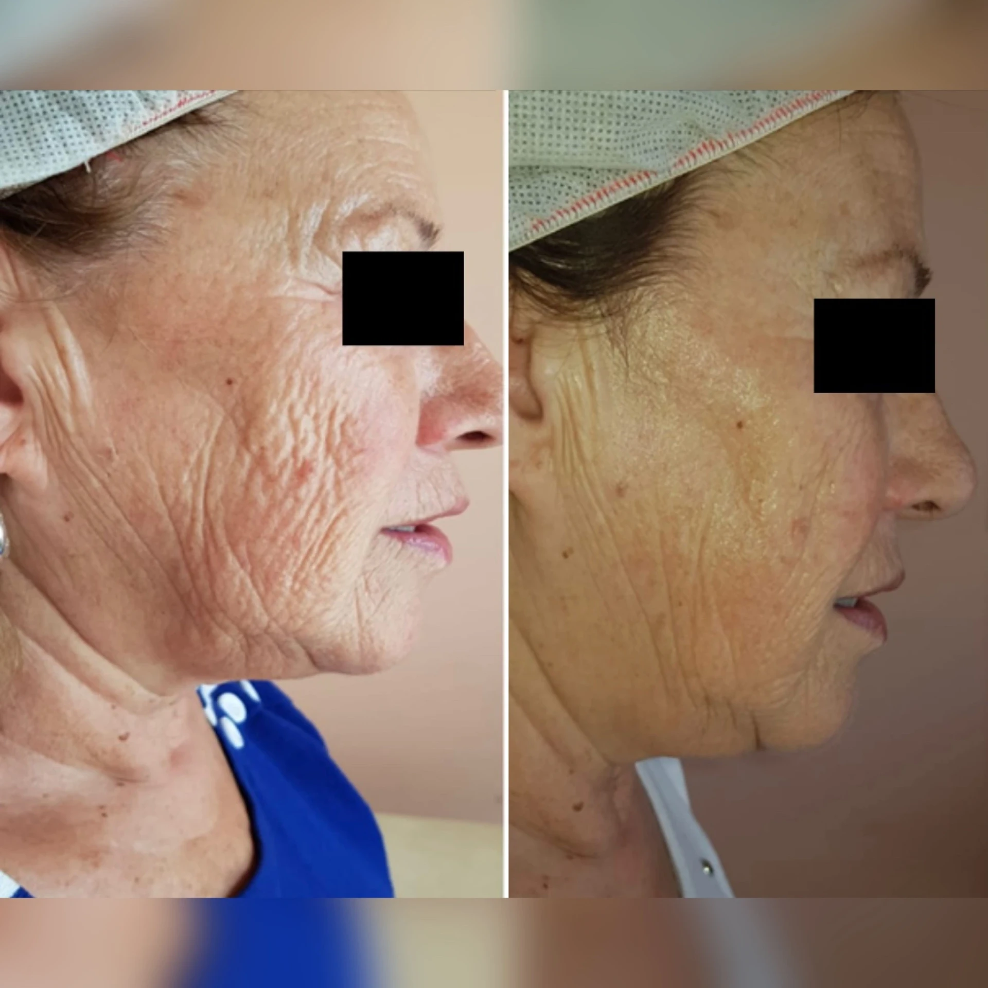 Caso real HIFU - 6 meses