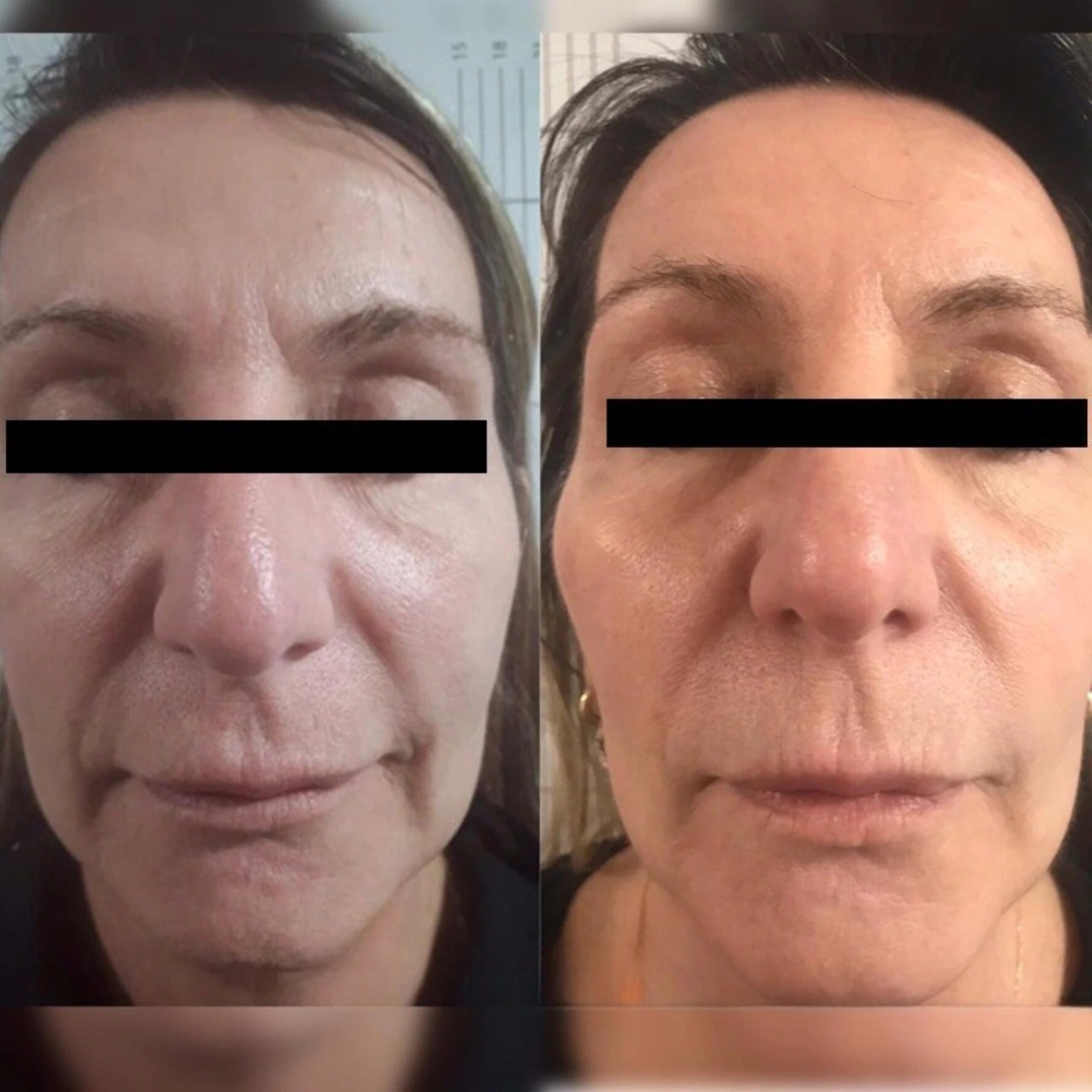 Caso real HIFU - antes y después facial