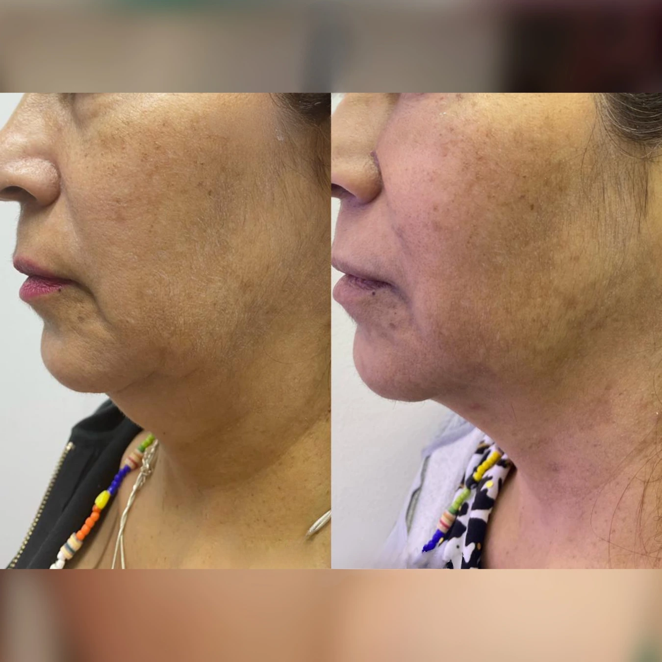 Caso real HIFU - antes y después mentón y cuello